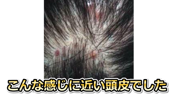 脂漏性皮膚炎の頭皮